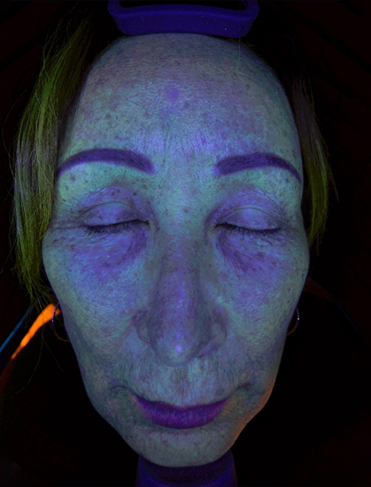 UV Light (Fluorescence Imaging)