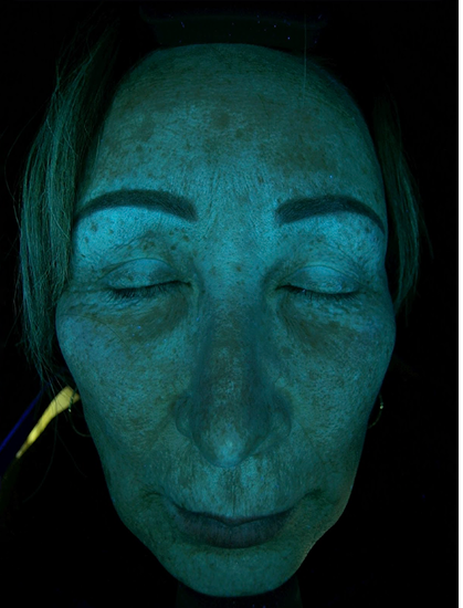 Wood’s Light (Pigmentation & Bacterial Analysis)